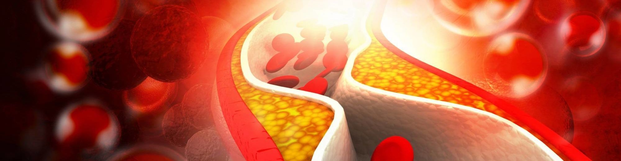 Cholesterol plaque in artery - Cardiovascular Disease (CVD) | Amarex